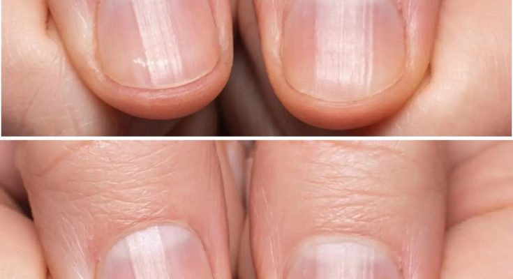 Having Striped Nails Could Mean That Your Body is….