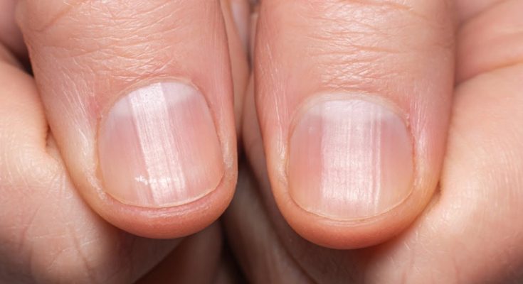 Having Striped Nails Could Mean That Your Body is…. Read more